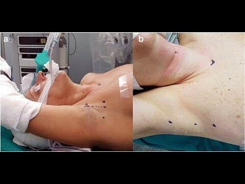 Avances en Tiroidectomía Robótica: Beneficios y Tecnología