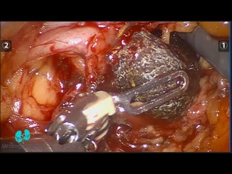 Revolución en la Pielolitotomía Robótica: Eficiencia y Precisión en Cirugía Renal