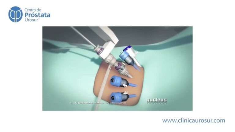 Avances en la prostatectomía radical robótica Da Vinci